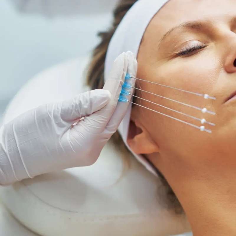 Hilos de colágeno (PDO)