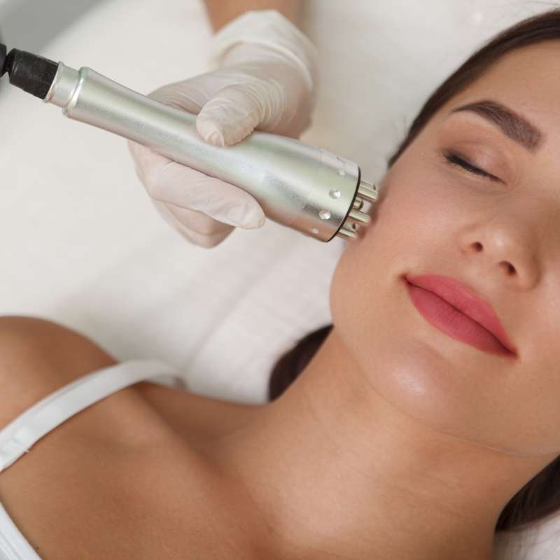 Radiofrecuencia fraccionada (Glowing Skin)